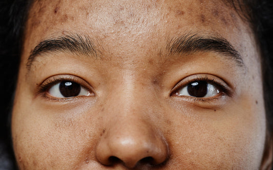 how to use zinc and castor oil ointment for dark spots and hyperpigmentation from acne scars